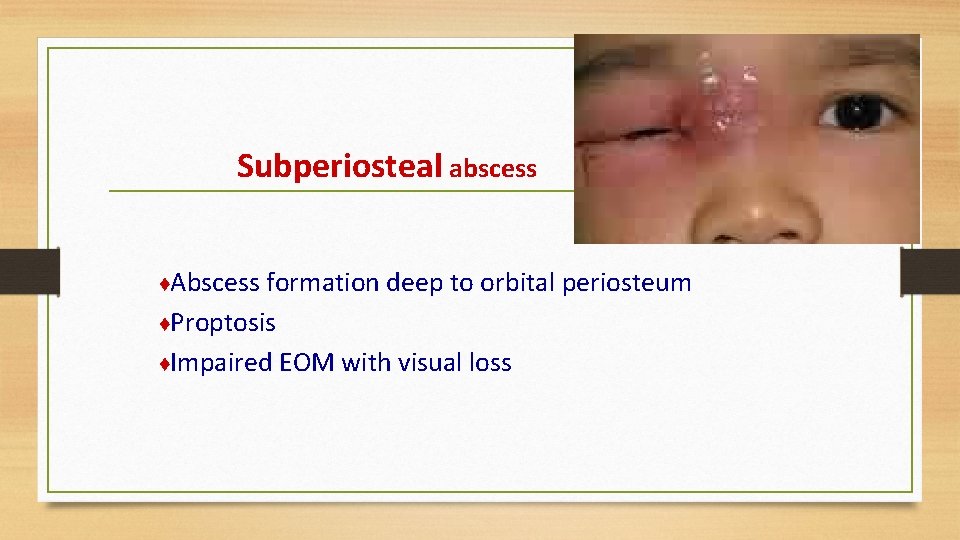 Subperiosteal abscess ♦Abscess formation deep to orbital periosteum ♦Proptosis ♦Impaired EOM with visual loss