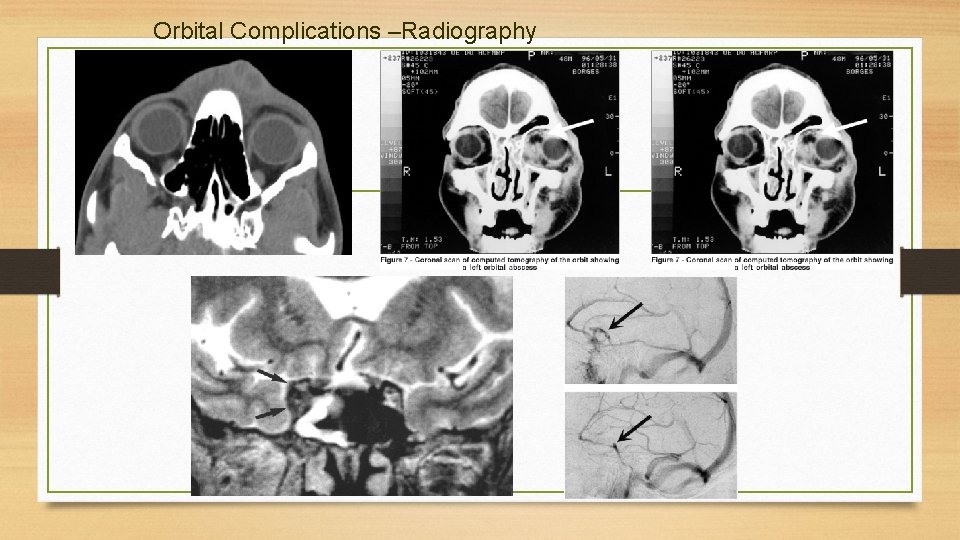 Orbital Complications –Radiography 