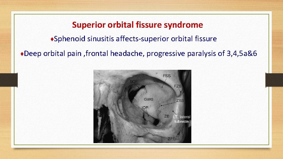 Superior orbital fissure syndrome ♦Sphenoid sinusitis affects-superior orbital fissure ♦Deep orbital pain , frontal