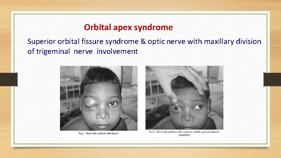 Orbital apex syndrome Superior orbital fissure syndrome & optic nerve with maxillary division of