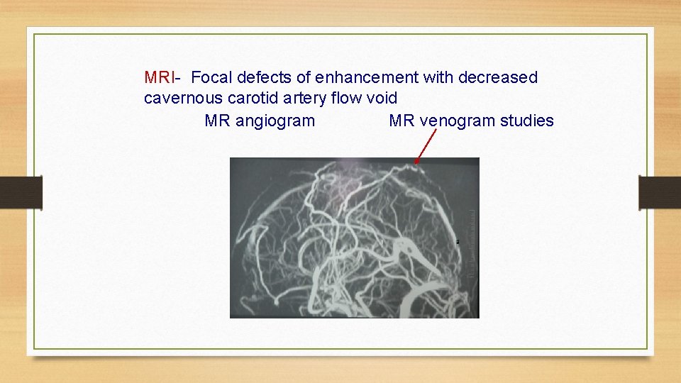 MRI- Focal defects of enhancement with decreased cavernous carotid artery flow void MR angiogram
