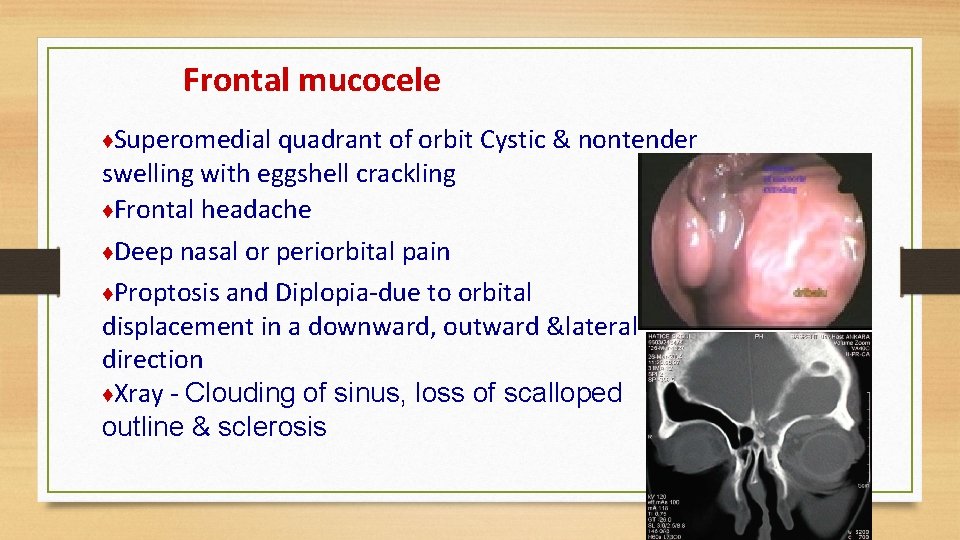 Frontal mucocele ♦Superomedial quadrant of orbit Cystic & nontender swelling with eggshell crackling ♦Frontal