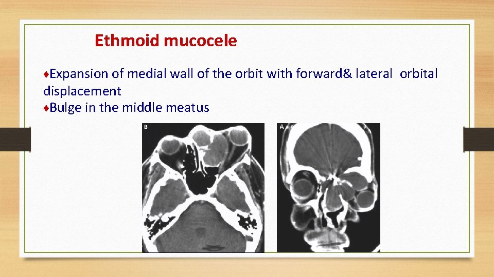 Ethmoid mucocele ♦Expansion of medial wall of the orbit with forward& lateral displacement ♦Bulge