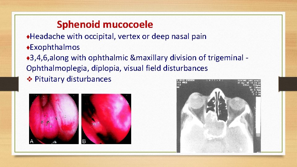 Sphenoid mucocoele ♦Headache with occipital, vertex or deep nasal pain ♦Exophthalmos ♦ 3, 4,