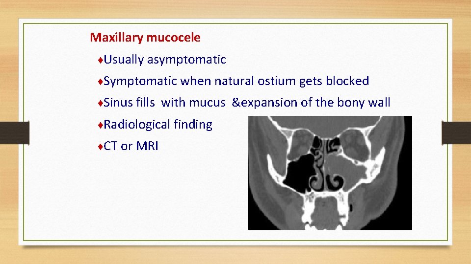Maxillary mucocele ♦Usually asymptomatic ♦Symptomatic when natural ostium gets blocked ♦Sinus fills with mucus