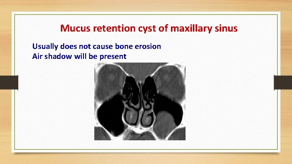 Mucus retention cyst of maxillary sinus Usually does not cause bone erosion Air shadow