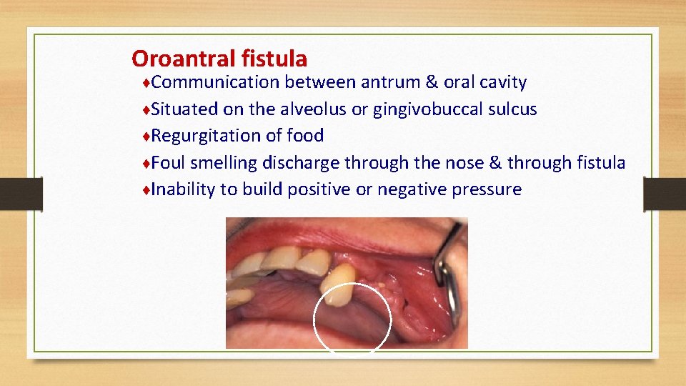 Oroantral fistula ♦Communication between antrum & oral cavity ♦Situated on the alveolus or gingivobuccal