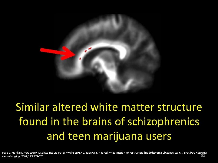 Similar altered white matter structure found in the brains of schizophrenics and teen marijuana Similar altered white matter structure found in the brains of schizophrenics and teen marijuana