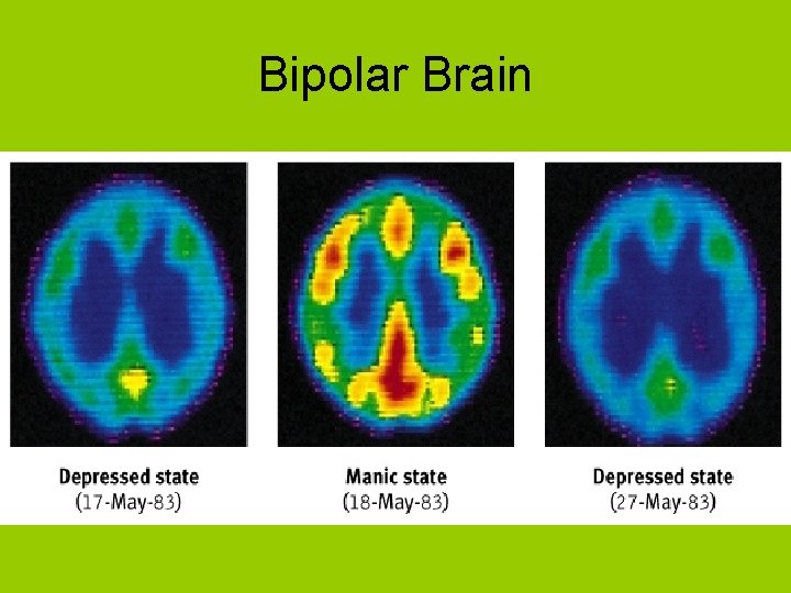 Bipolar Brain 