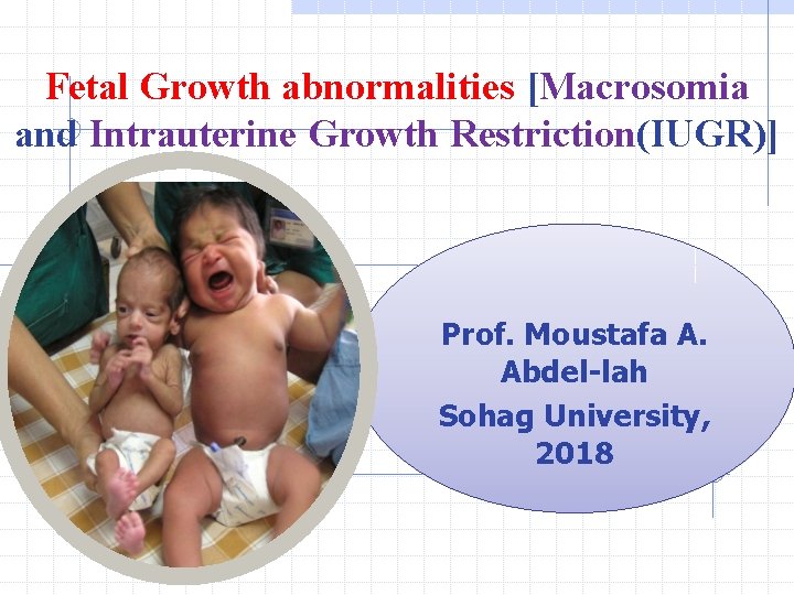 Fetal Growth abnormalities [Macrosomia and Intrauterine Growth Restriction(IUGR)] Prof. Moustafa A. Abdel-lah Sohag University,