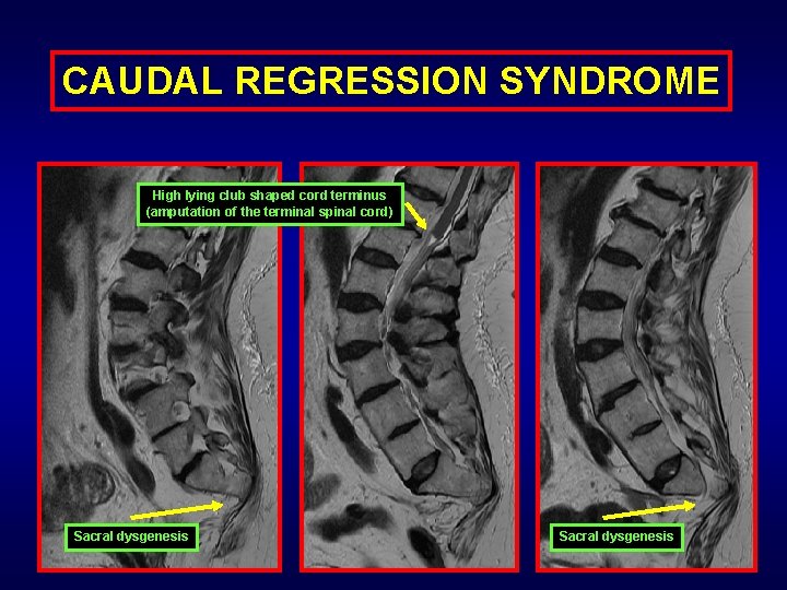 CAUDAL REGRESSION SYNDROME High lying club shaped cord terminus (amputation of the terminal spinal