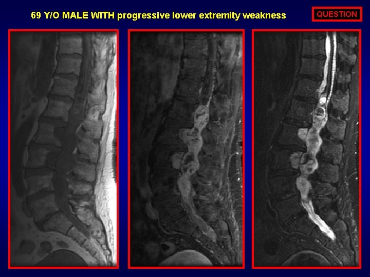 69 Y/O MALE WITH progressive lower extremity weakness QUESTION 