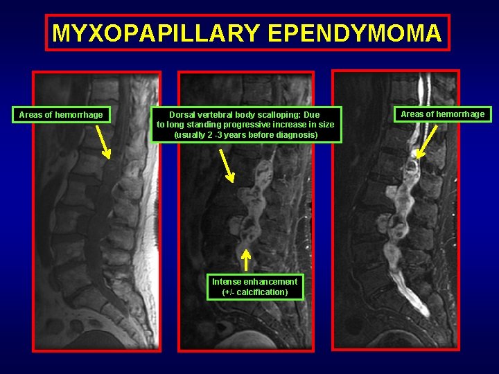 MYXOPAPILLARY EPENDYMOMA Areas of hemorrhage Dorsal vertebral body scalloping: Due to long standing progressive