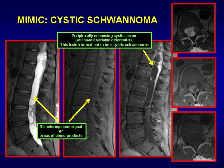 MIMIC: CYSTIC SCHWANNOMA Peripherally enhancing cystic lesion (will have a variable differential). This lesion