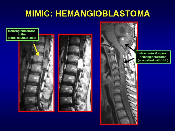 MIMIC: HEMANGIOBLASTOMA Hemangioblastoma in the cauda equina region Intracranial & spinal hemangioblastoma (in a