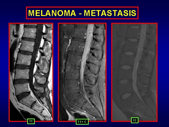 MELANOMA - METASTASIS T 1 + C T 2 