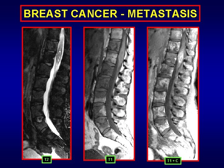 BREAST CANCER - METASTASIS T 2 T 1 + C 