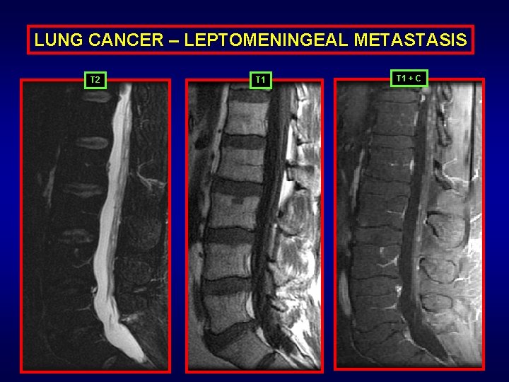 LUNG CANCER – LEPTOMENINGEAL METASTASIS T 2 T 1 + C 