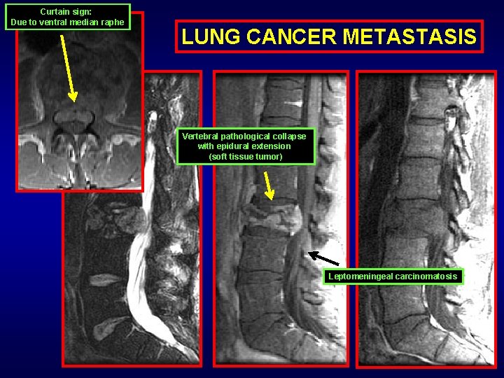 Curtain sign: Due to ventral median raphe LUNG CANCER METASTASIS Vertebral pathological collapse with