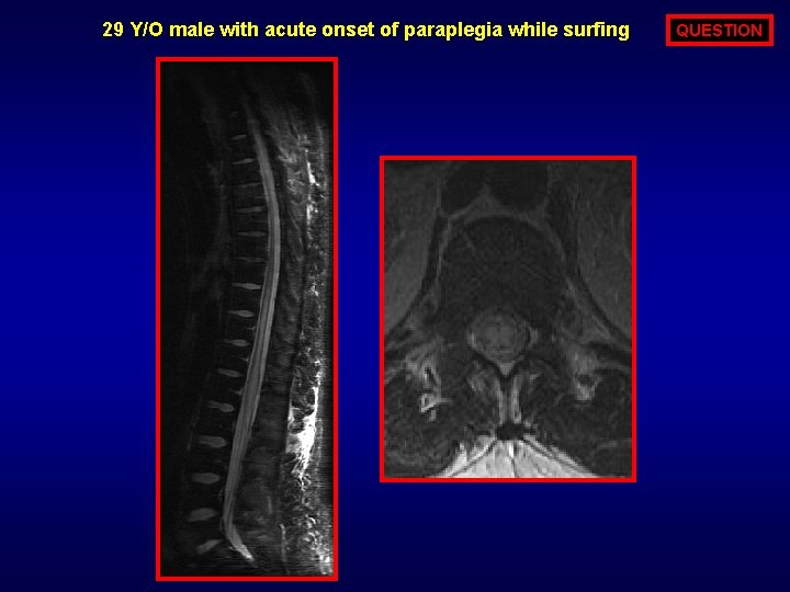 29 Y/O male with acute onset of paraplegia while surfing QUESTION 