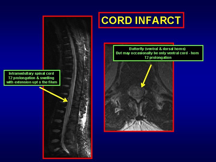 CORD INFARCT Butterfly (ventral & dorsal horns) But may occasionally be only ventral cord