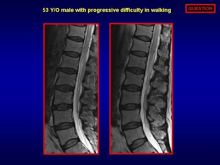 53 Y/O male with progressive difficulty in walking QUESTION 