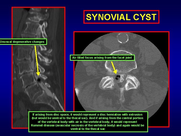 SYNOVIAL CYST Unusual degenerative changes Air filled focus arising from the facet joint If