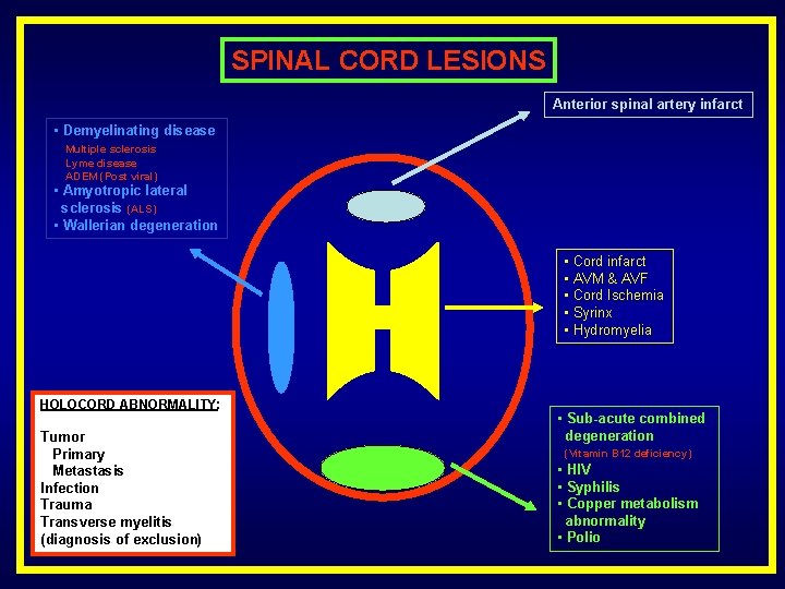 SPINAL CORD LESIONS Anterior spinal artery infarct • Demyelinating disease Multiple sclerosis Lyme disease