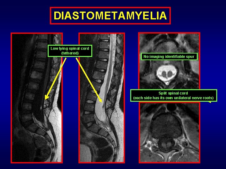 DIASTOMETAMYELIA Low lying spinal cord (tethered) No imaging identifiable spur Split spinal cord (each