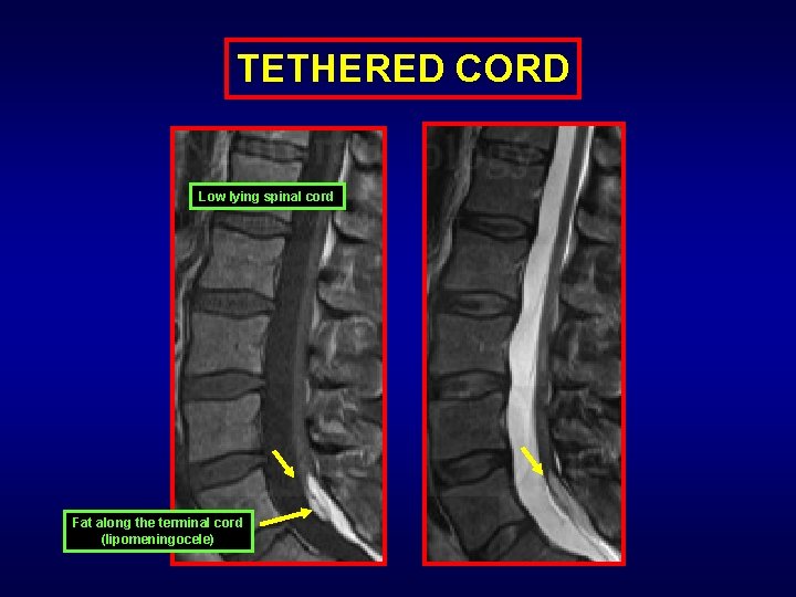 TETHERED CORD Low lying spinal cord Fat along the terminal cord (lipomeningocele) 
