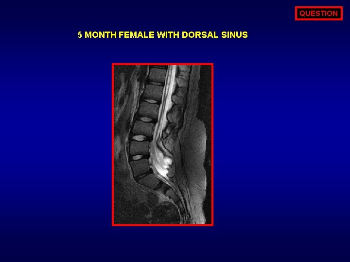 QUESTION 5 MONTH FEMALE WITH DORSAL SINUS 