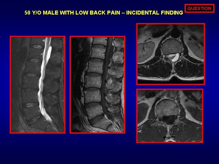 50 Y/O MALE WITH LOW BACK PAIN – INCIDENTAL FINDING QUESTION 