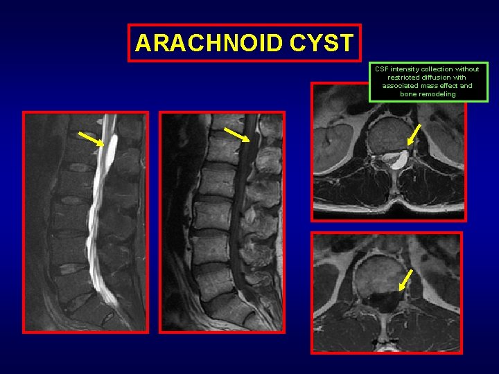 ARACHNOID CYST CSF intensity collection without restricted diffusion with associated mass effect and bone