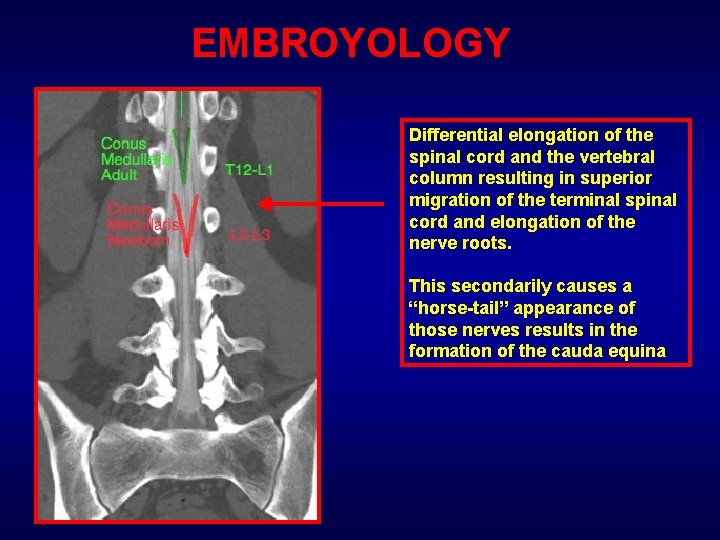 EMBROYOLOGY Differential elongation of the spinal cord and the vertebral column resulting in superior