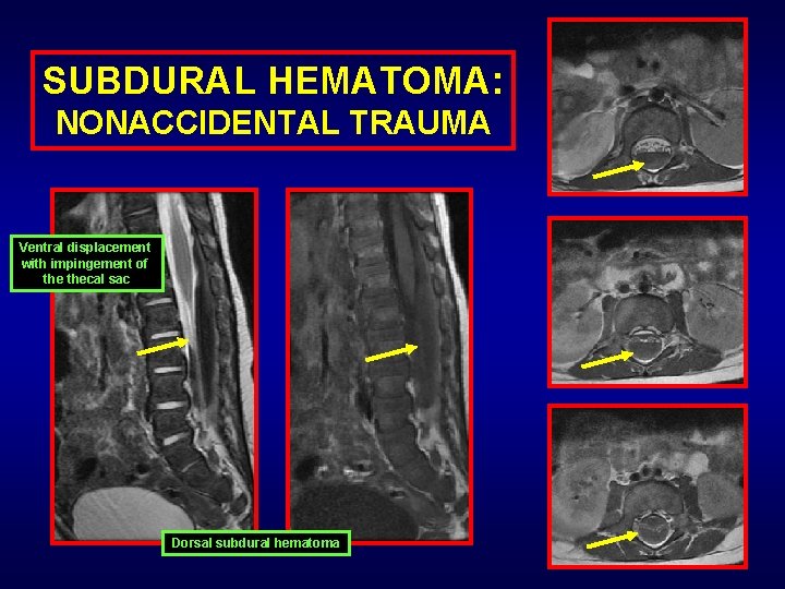 SUBDURAL HEMATOMA: NONACCIDENTAL TRAUMA Ventral displacement with impingement of thecal sac Dorsal subdural hematoma
