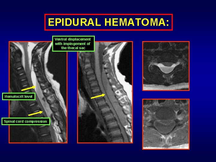 EPIDURAL HEMATOMA: Ventral displacement with impingement of thecal sac Hematocrit level Spinal cord compression
