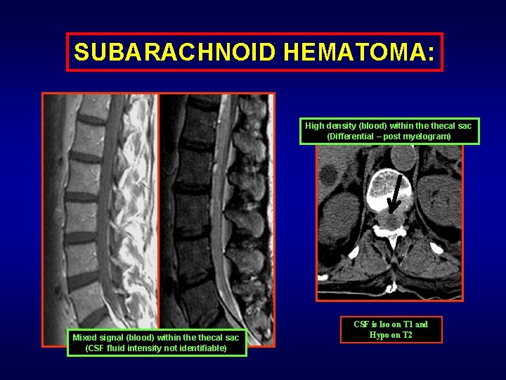SUBARACHNOID HEMATOMA: High density (blood) within thecal sac (Differential – post myelogram) Mixed signal