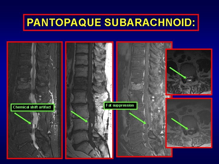PANTOPAQUE SUBARACHNOID: Chemical shift artifact Fat suppression 