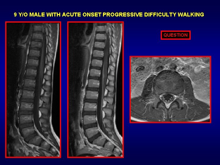 9 Y/O MALE WITH ACUTE ONSET PROGRESSIVE DIFFICULTY WALKING QUESTION 