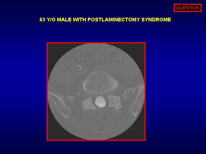 QUESTION 63 Y/O MALE WITH POSTLAMINECTOMY SYNDROME 