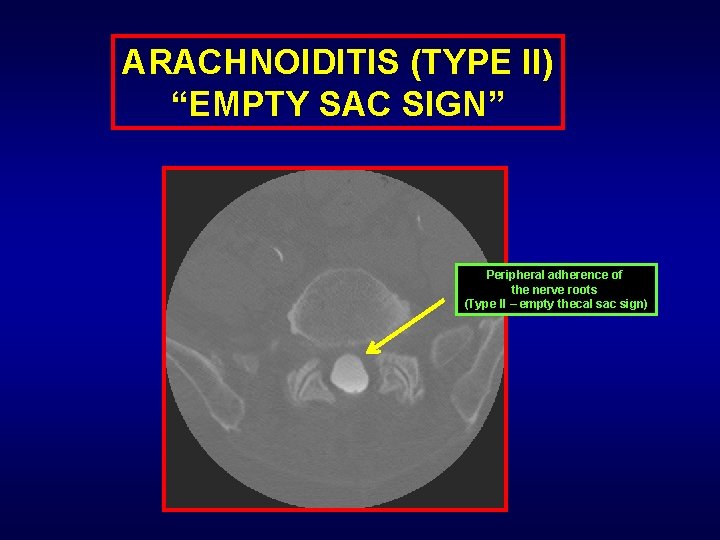 ARACHNOIDITIS (TYPE II) “EMPTY SAC SIGN” Peripheral adherence of the nerve roots (Type II