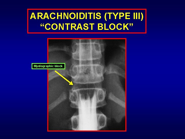 ARACHNOIDITIS (TYPE III) “CONTRAST BLOCK” Myelographic block 