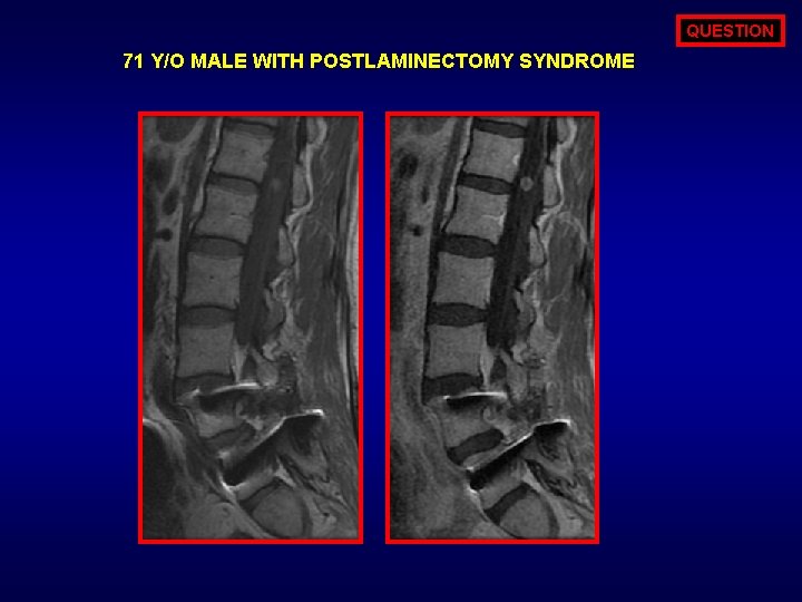 QUESTION 71 Y/O MALE WITH POSTLAMINECTOMY SYNDROME 