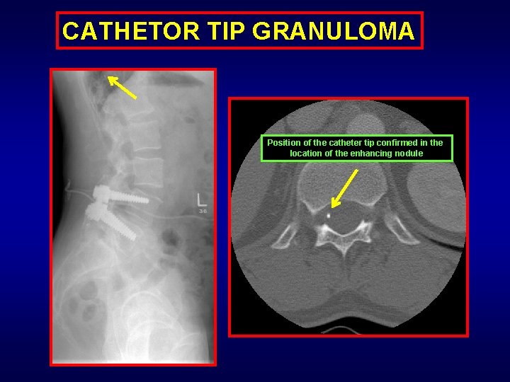 CATHETOR TIP GRANULOMA Position of the catheter tip confirmed in the location of the