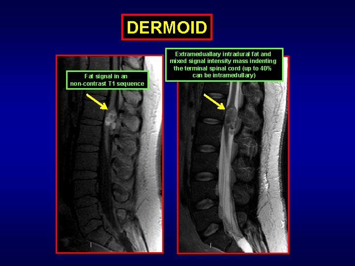DERMOID Fat signal in an non-contrast T 1 sequence Extrameduallary intradural fat and mixed