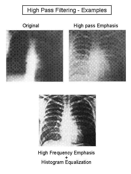 High Pass Filtering - Examples Original High pass Emphasis High Frequency Emphasis + Histogram