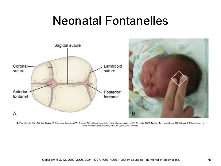 Neonatal Fontanelles Copyright © 2012, 2009, 2005, 2001, 1997, 1993, 1988, 1983 by Saunders, Neonatal Fontanelles Copyright © 2012, 2009, 2005, 2001, 1997, 1993, 1988, 1983 by Saunders,