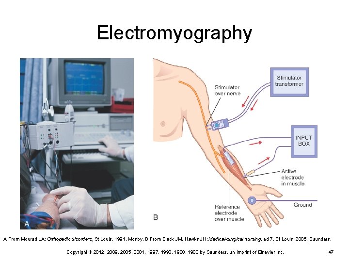 Electromyography A From Mourad LA: Orthopedic disorders, St Louis, 1991, Mosby. B From Black Electromyography A From Mourad LA: Orthopedic disorders, St Louis, 1991, Mosby. B From Black