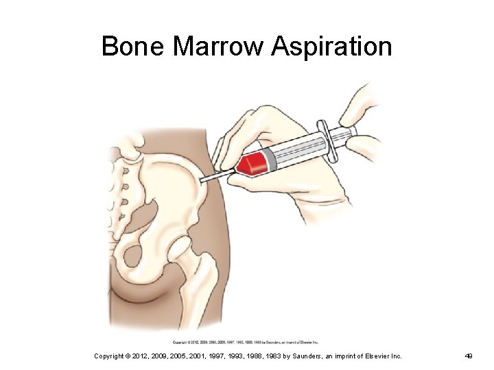 Bone Marrow Aspiration Copyright © 2012, 2009, 2005, 2001, 1997, 1993, 1988, 1983 by Bone Marrow Aspiration Copyright © 2012, 2009, 2005, 2001, 1997, 1993, 1988, 1983 by