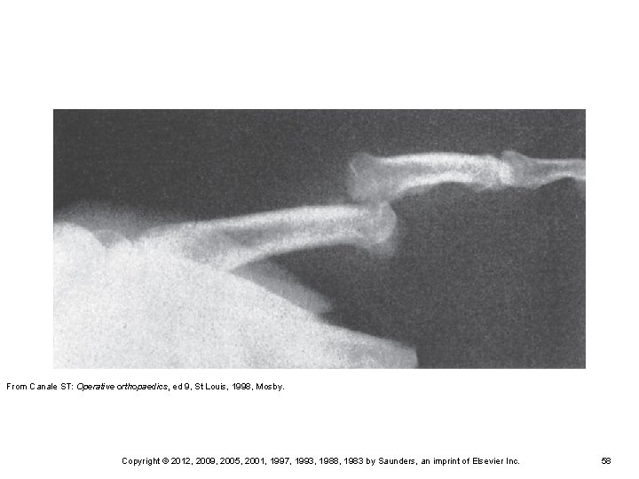 From Canale ST: Operative orthopaedics, ed 9, St Louis, 1998, Mosby. Copyright © 2012, From Canale ST: Operative orthopaedics, ed 9, St Louis, 1998, Mosby. Copyright © 2012,